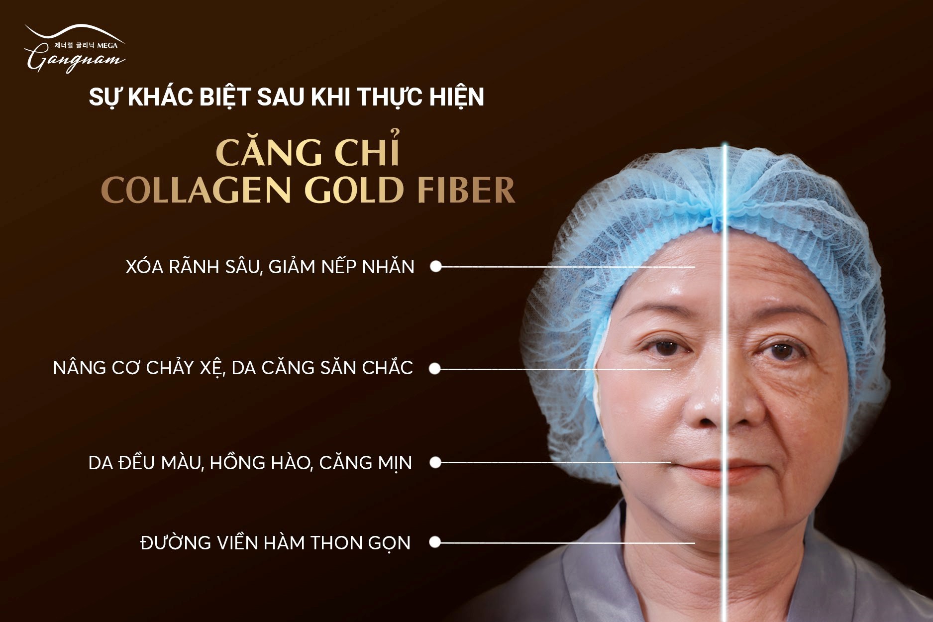 Hiệu quả vượt trội của căng chỉ Collagen Gold Fiber