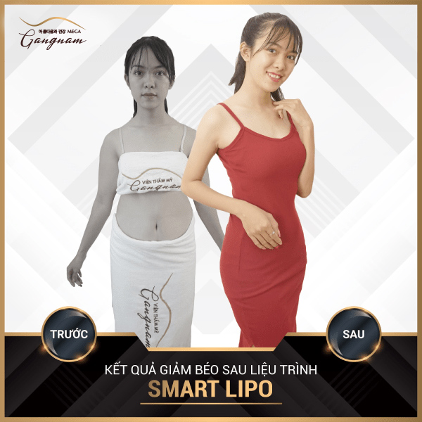 Vòng eo “chuẩn body” của chị Linh khi giảm tới 26 cm vòng bụng với Smart Lipo