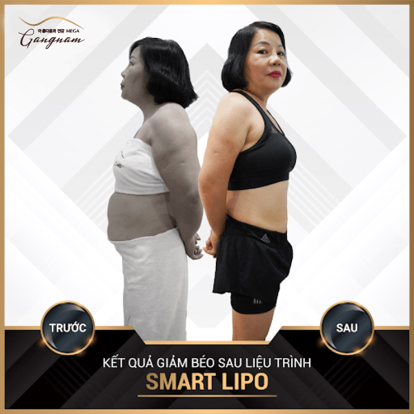 Liệu trình giảm béo Smart Lipo đã giúp cô Hạnh giảm 32 cm vòng bụng và 8,5 kg cân nặng.