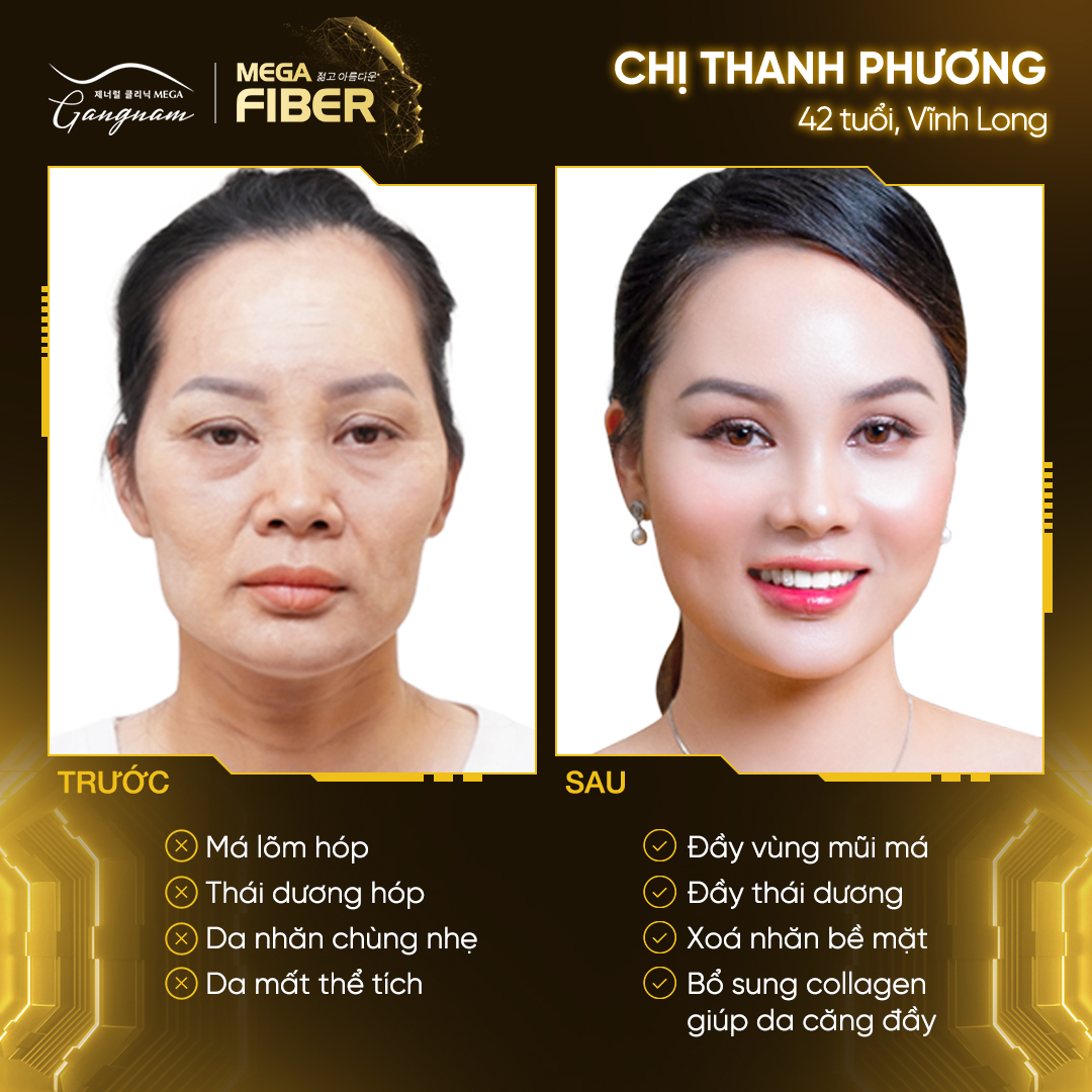 Chị Thanh Phương trước và sau khi sử dụng liệu trình Mega Fiber