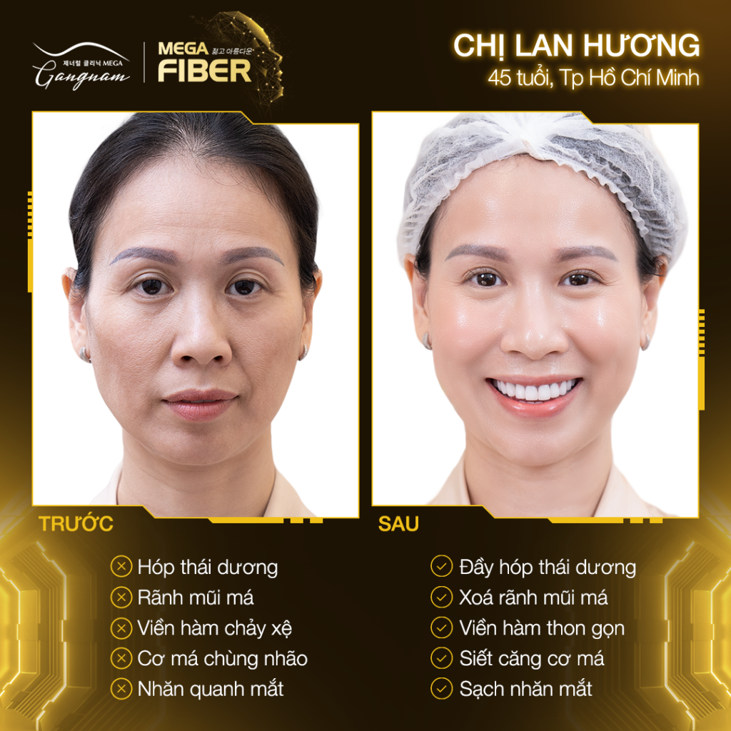 Chị Lan Hương trước và sau khi sử dụng liệu trình Mega Fiber