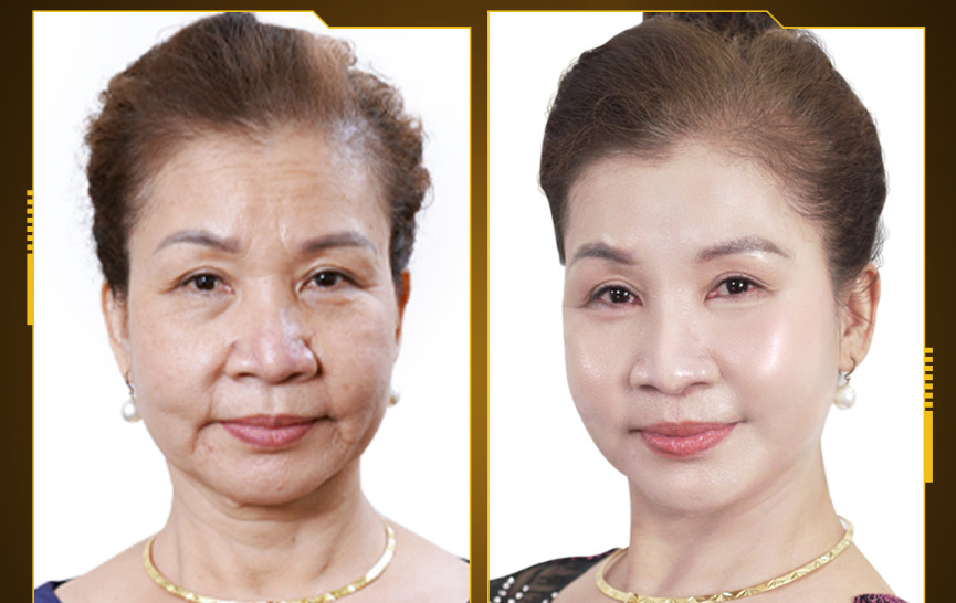 Sister Cat Tuyen Before and After Using the Mega Fiber Treatment