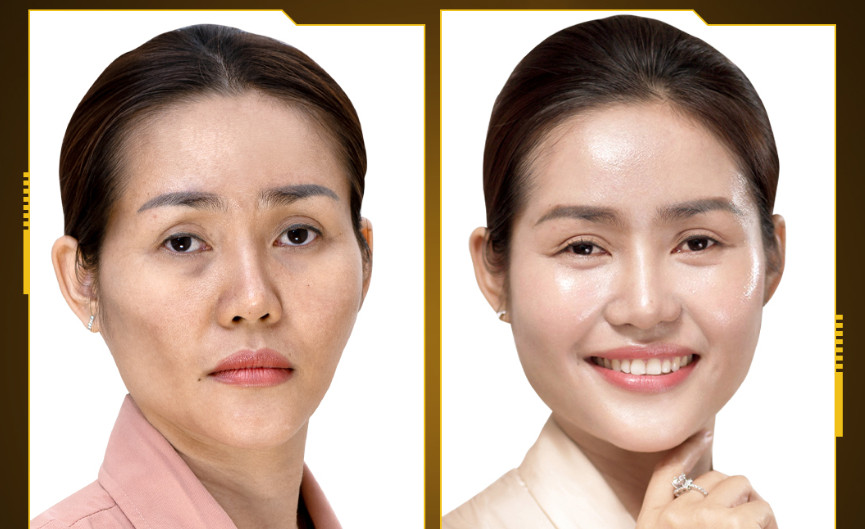 Mrs. Minh Huyen Before and After Using the Mega Fiber Treatment