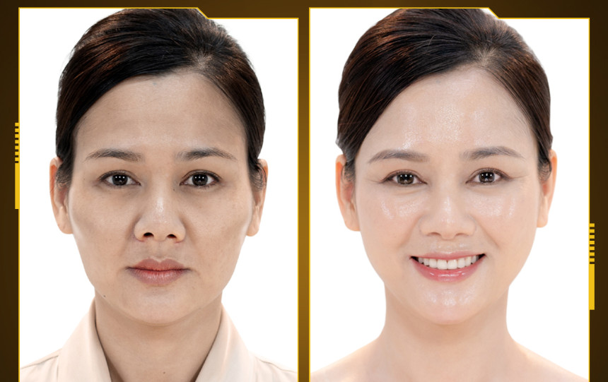 Mrs. Huyen Sam Before and After Using the Mega Fiber Treatment