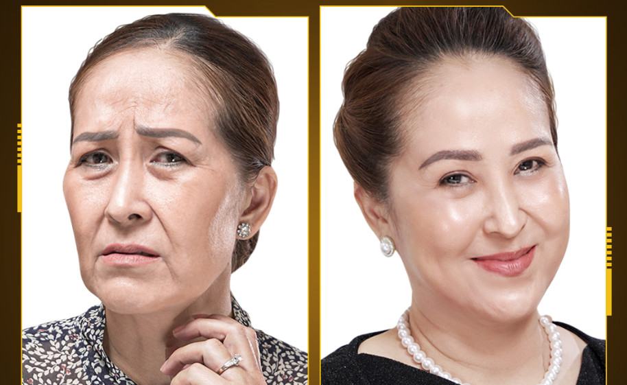 Mrs. Ngoc Huyen Before and After Using the Mega Fiber Treatment