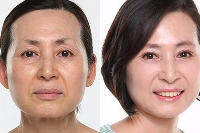 Hình ảnh trước và sau khi căng da mặt