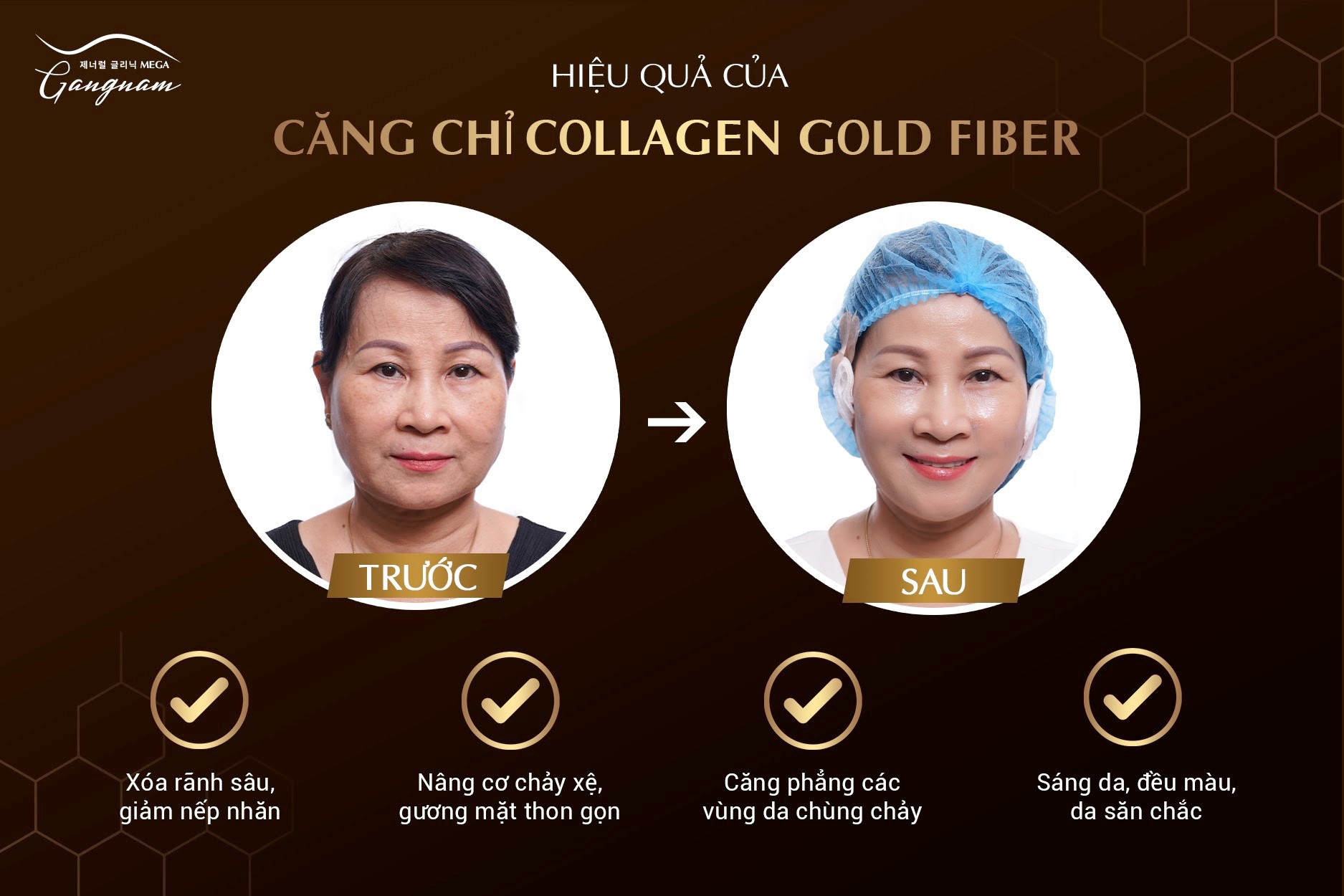 Collagen Gold Fiber giảm nếp nhăn trán chỉ sau 1 giờ
