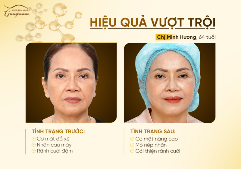 Tình trạng da sau căng chỉ collagen vàng của chị Minh Hương 