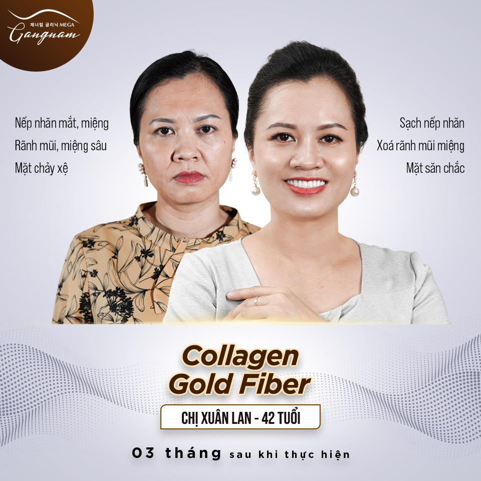 Căng chỉ Collagen Gold Fiber là phương pháp hiện đại hiệu quả cao