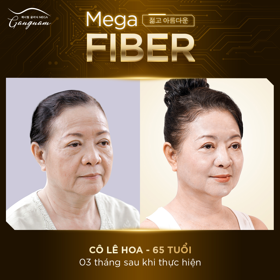 Căng da mặt bằng công nghệ trẻ hóa tự thân MEGA FIBER 
