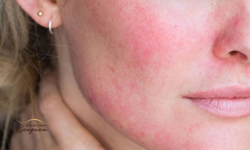 Hiện tượng da mặt đỏ tấy, bỏng rát khá phổ biến sau khi căng da mặt