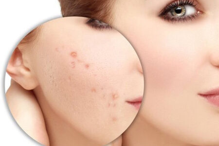 Chăm sóc da đúng cách giúp thảm thiệu các vết mụn trên da mặt