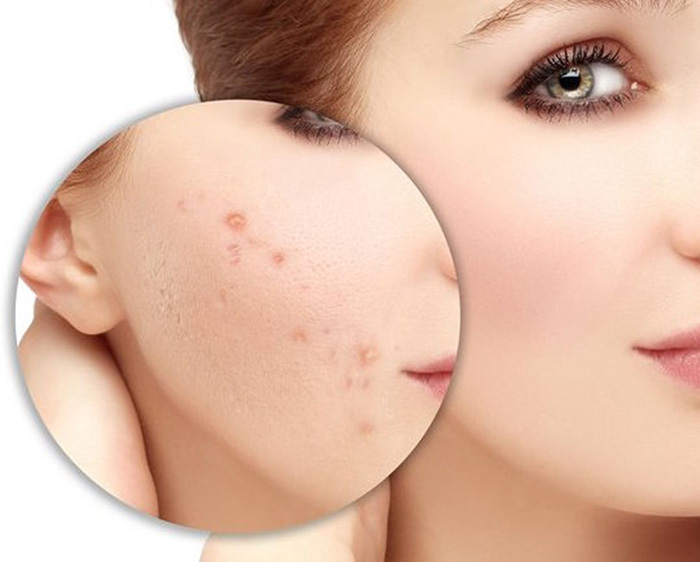 Chăm sóc da đúng cách giúp thảm thiệu các vết mụn trên da mặt