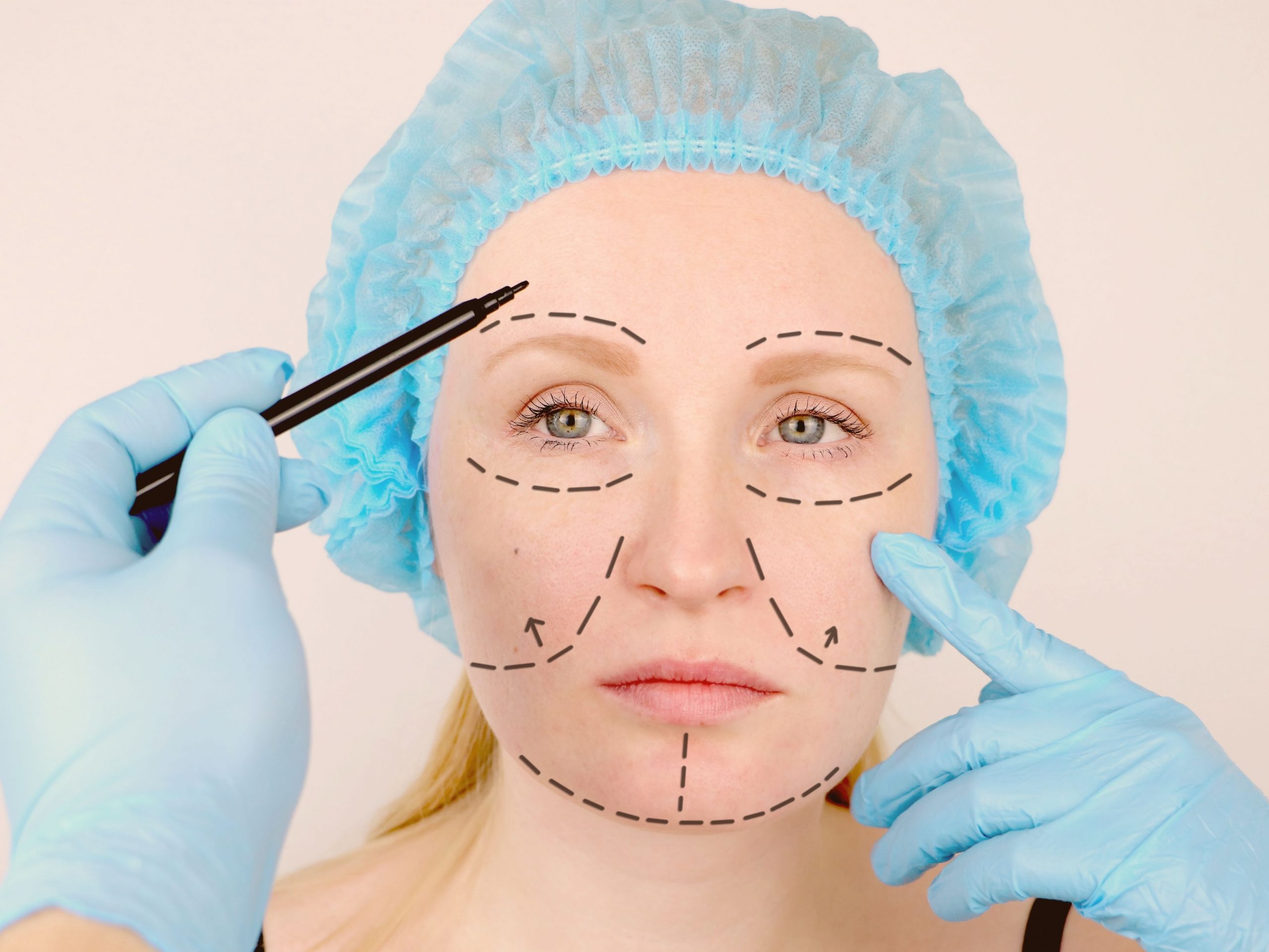 Phương pháp phẫu thuật căng da mặt sẽ thực hiện cắt bỏ phần da thừa