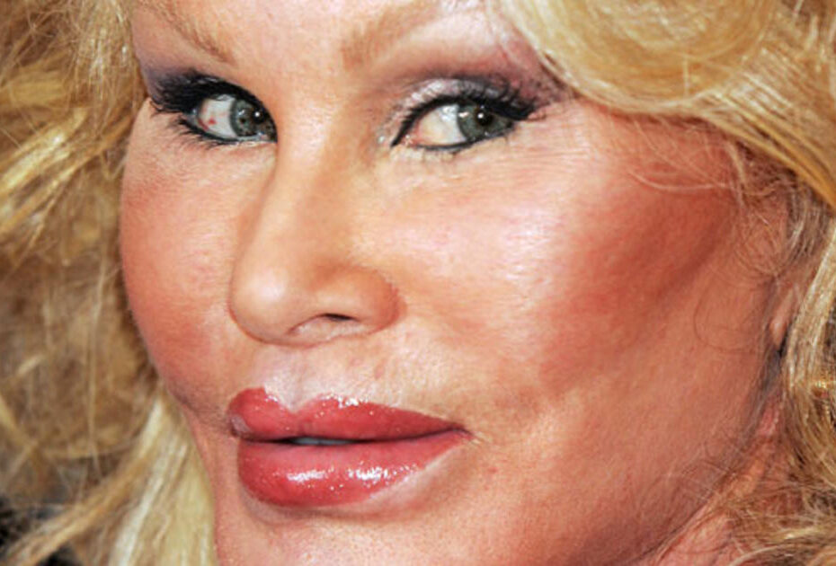 Tác hại của thực hiện căng da mặt bằng kỹ thuật kém chất lượng Tác hại của thực hiện căng da mặt bằng kỹ thuật kém chất lượng