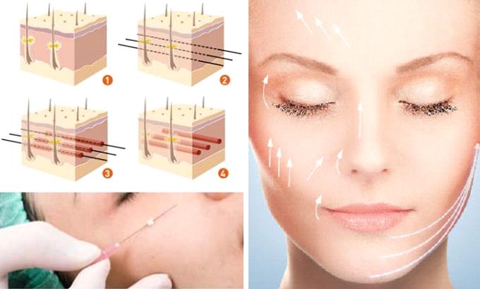 Phẫu thuật căng da mặt bằng chỉ collagen