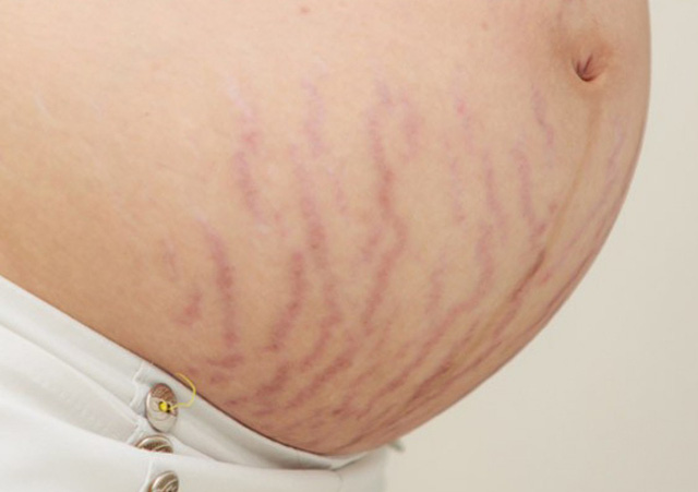 Các vết rạn da nặng nề xuất hiện cả trước và sau khi sinh