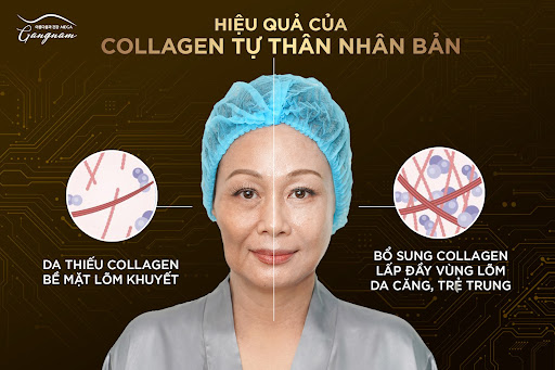 Hiệu quả đạt được sau khi thực hiện liệu trình Collagen tự thân nhân bản