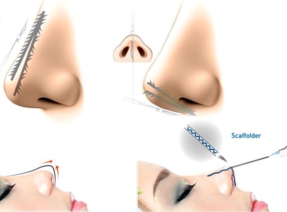Quy trình nâng mũi bằng phương pháp cấy chỉ bao gồm 5 bước cơ bản