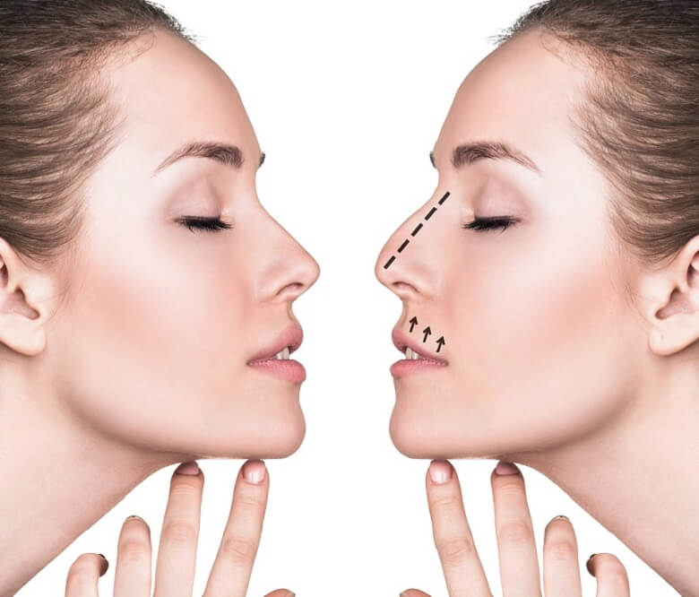 Nâng mũi bằng chỉ collagen có an toàn không? 
