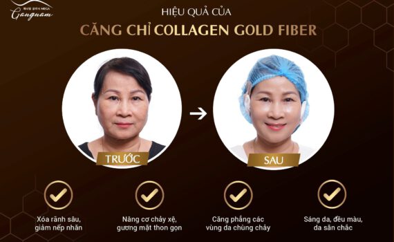 Hiệu quả của căng chỉ collagen tại Mega Gangnam