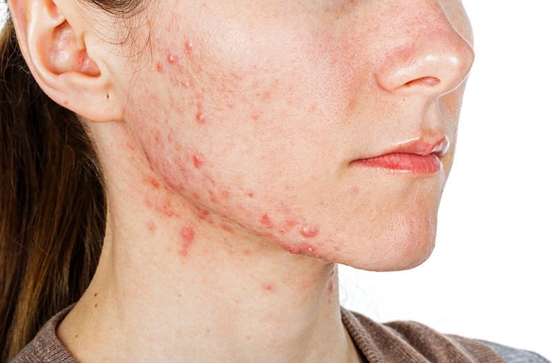 Bị ngứa da mặt có nguy hiểm không?