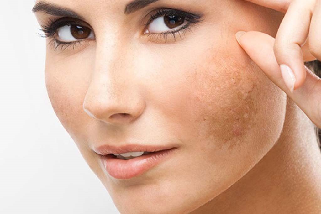 Làn da bị tối màu và sạm có thể tái tạo da để cải thiện làn da hơn 