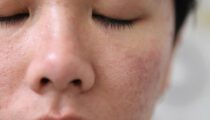 Da mặt bị ngứa là bệnh gì?
