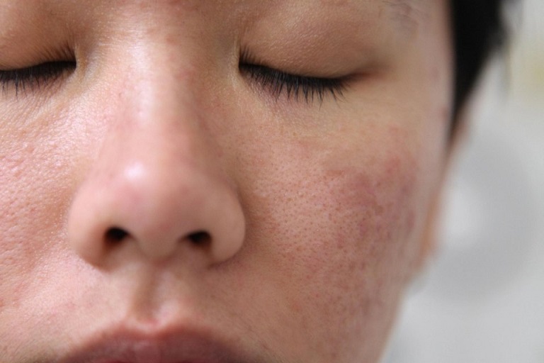 Da mặt bị ngứa là bệnh gì?