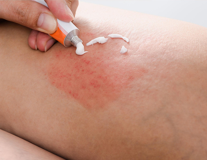 Có nhiều phương pháp có thể điều trị được viêm lỗ chân lông hiệu quả
