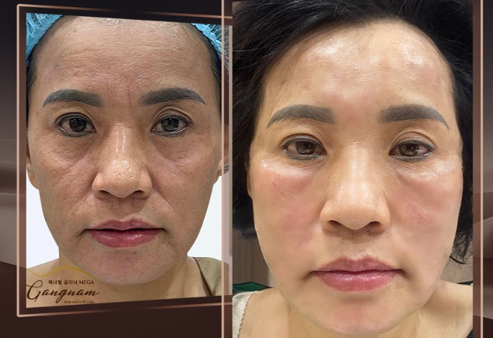 Chị Lan 38 tuổi ở Hà Nội trước và sau khi căng trán