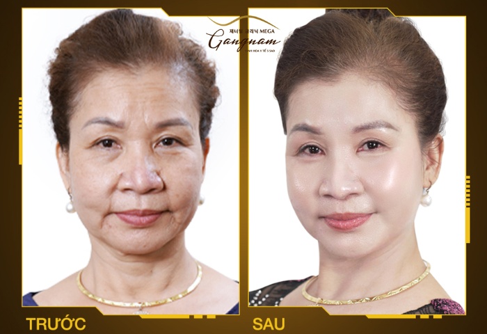 Chị Thư 49 tuổi ở Đà Nẵng trước và sau khi căng trán