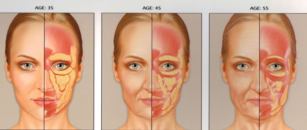 Cấu trúc vùng da mặt, đặc biệt là vùng má giảm dần do lão hóa 