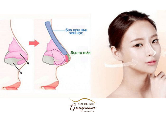 Phương pháp nâng mũi bằng sụn tự thân