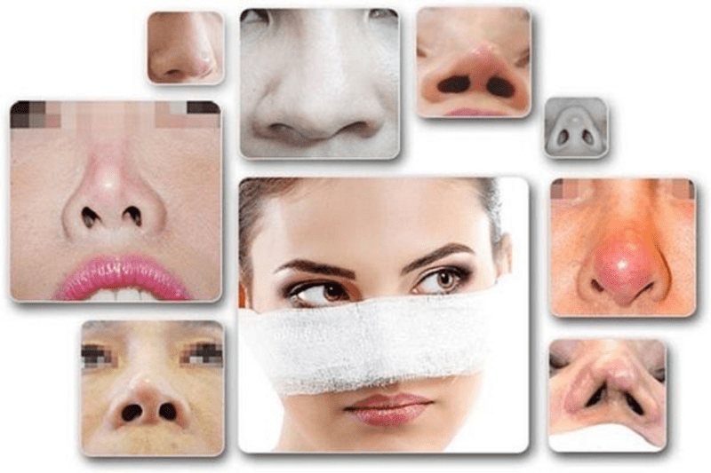 Những triệu chứng thường gặp sau quá trình nâng mũi 