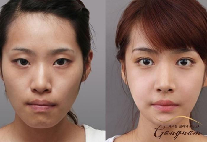 Những phương pháp khắc phục má bị lệch và cân chỉnh khuôn mặt an toàn nhất