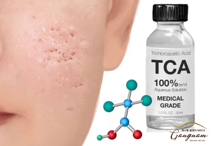 Trichloroacetic acid (TCA)