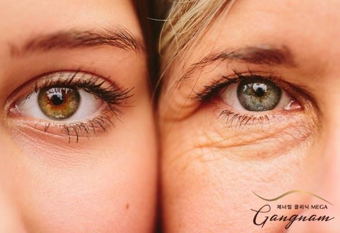 Nguyên nhân và những cách điều trị da vùng mắt bị lão hóa hiệu quả