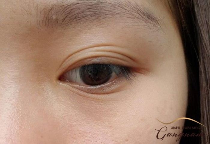 Những nguyên nhân phổ biến có thể khiến mắt xuất hiện nhiều nếp gấp