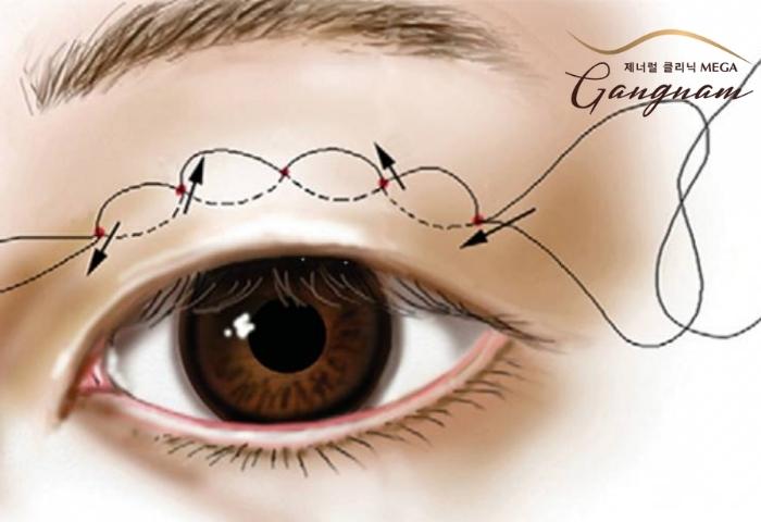 Nâng mí mắt bằng chỉ được áp dụng để điều trị sụp mí