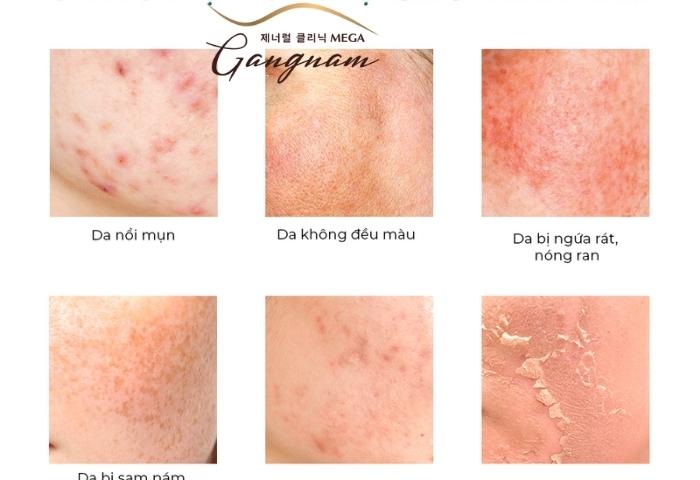 Những công dụng của phương pháp peel đối với làn da