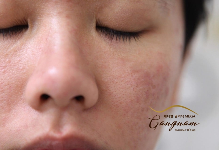 Dị ứng hoặc chăm sóc da không tốt khiến da sần sùi, thô ráp