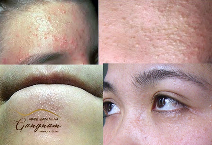 Những vùng da thường xuyên bị mụn ẩn trên mặt là trán, má và cằm
