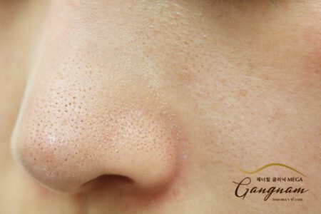 Mụn li ti trên da mặt là tình trạng gì? Phương pháp điều trị đúng cách