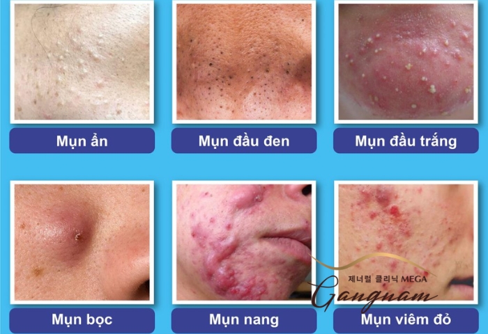 Các dạng mụn viêm phổ biến nhất và có khả năng diễn biến nặng hơn trên da