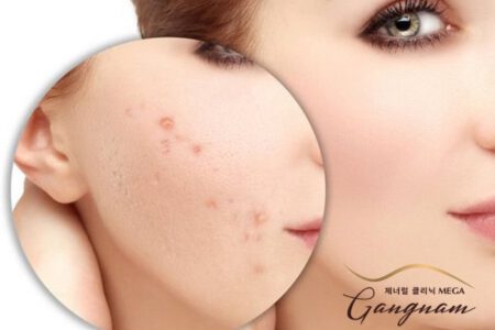 Mụn là một trong số những nguyên nhân lớn nhất gây sẹo trên da