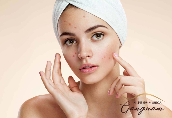 Chăm sóc da mặt khi bị sẹo thâm như thế nào đúng cách?