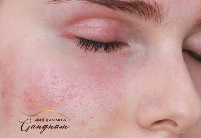 Nhận biết biểu hiện da mặt nhạy cảm như thế nào?
