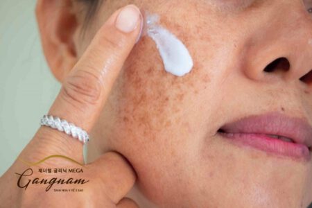 Sử dụng kem trị nám da mặt có hiệu quả không?
