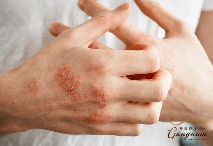 Phương pháp điều trị chàm da